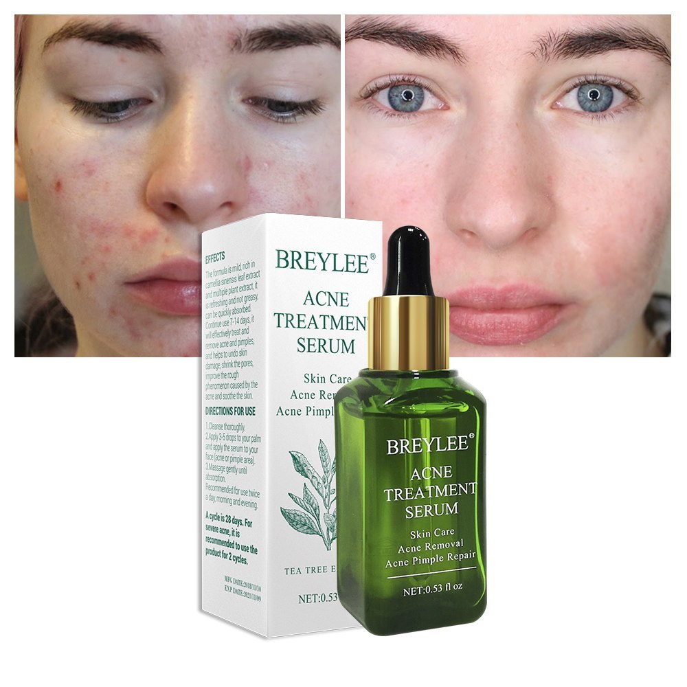 BREYLEE Acne Treatment Serum Face Facial Anti Acne Scar Beauty DealSniper.net