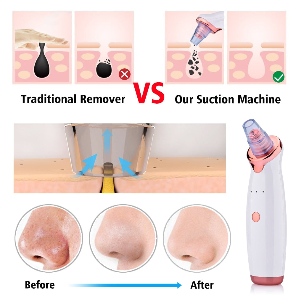 Blackhead Instrument Electric Suction Facial Washing Instrument Beauty Acne Cleaning Blackhead Suction Instrument Health dealsniper-net