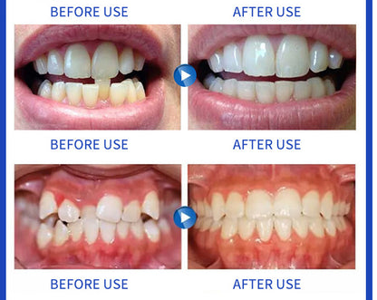 Invisible Braces Braces Transparent Health dealsniper-net