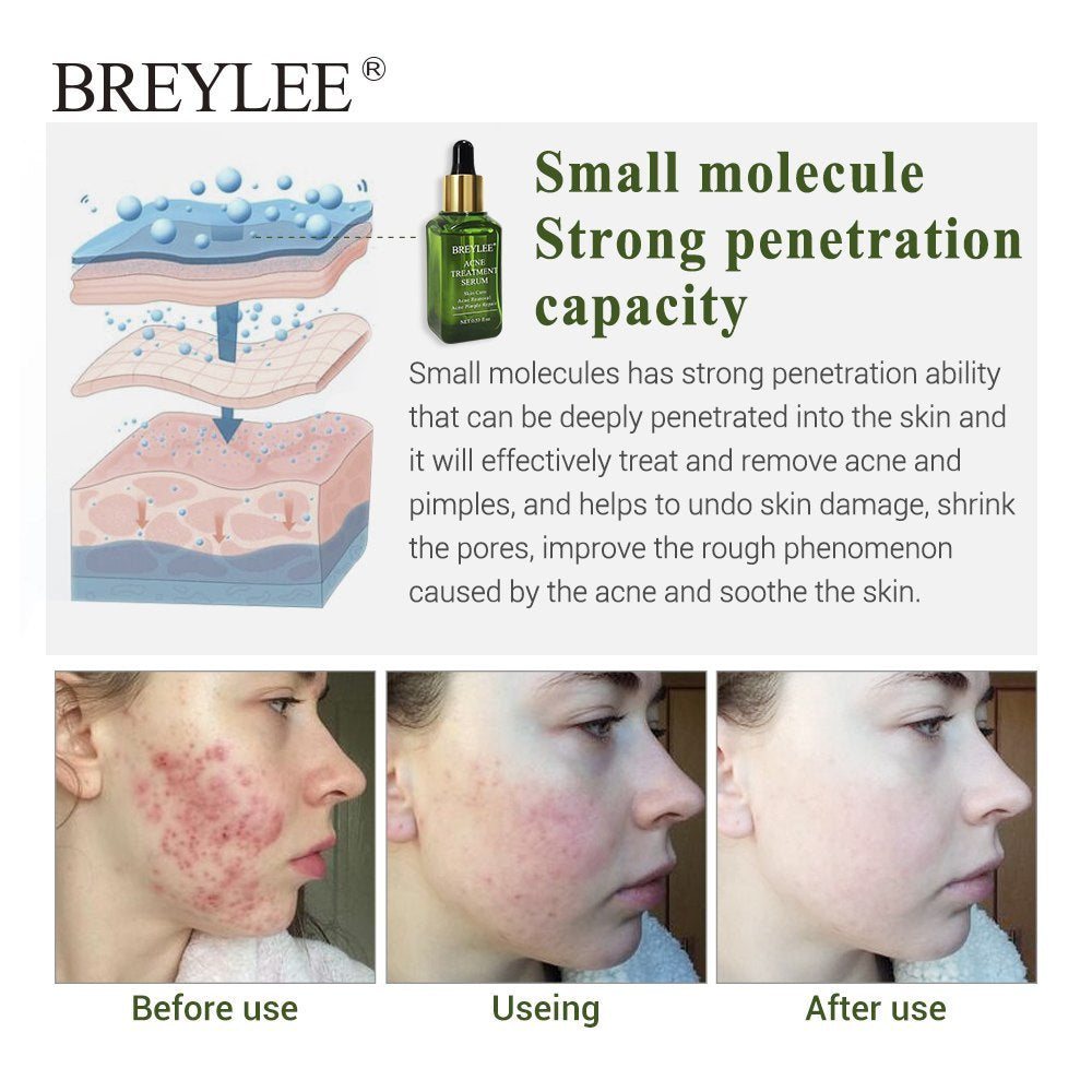BREYLEE Acne Treatment Serum Face Facial Anti Acne Scar Beauty DealSniper.net