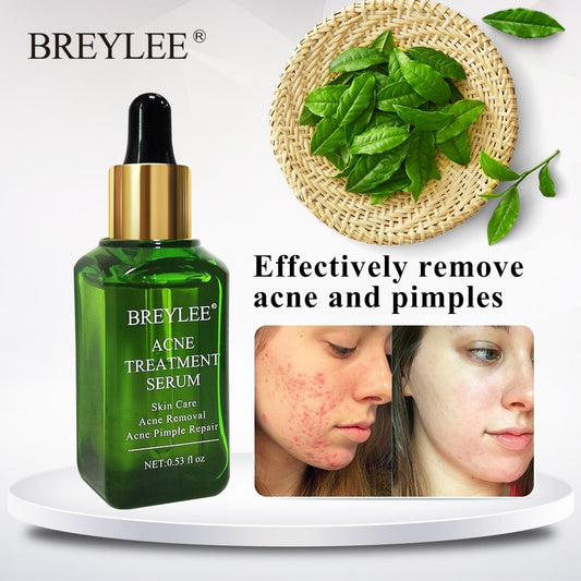 BREYLEE Acne Treatment Serum Face Facial Anti Acne Scar