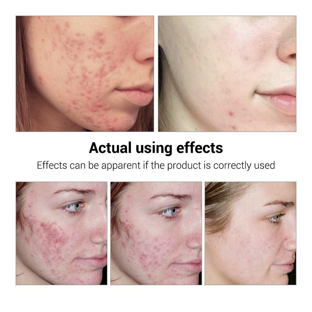 BREYLEE Acne Treatment Serum Face Facial Anti Acne Scar Beauty DealSniper.net