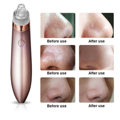 Electric Blackhead Vacuum Pore Cleaner Acne Pimple Remover