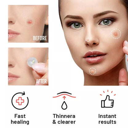 Chin Acne Day And Night Use Repair Acne Patch Beauty BlenderJuice.com CJ