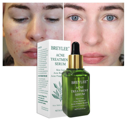 BREYLEE Acne Treatment Serum Face Facial Anti Acne Scar Beauty DealSniper.net