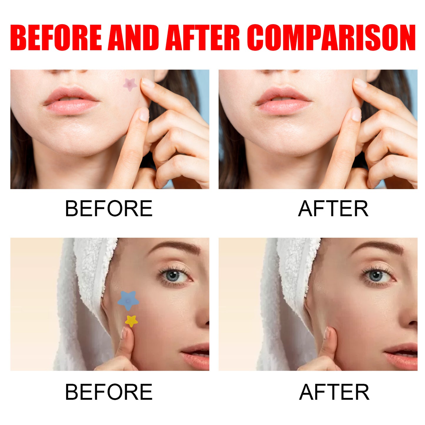 Pimple Patches For Face Hydrocolloid Acne Patches Beauty DealSniper.net