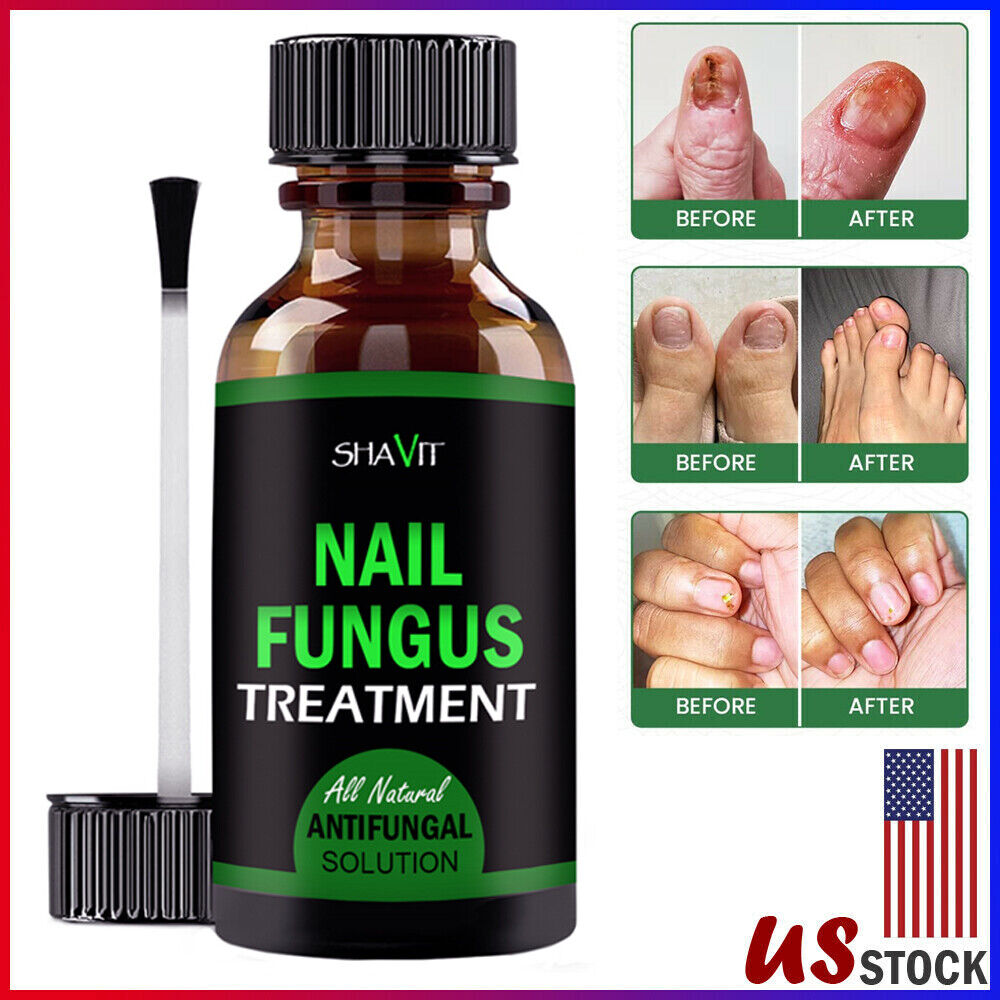 Toenail And Fingernail Fungus Treatment Extra Strength Antifungal Athletes Foot Health DealSniper.net