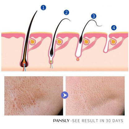 Hair Growth Inhibition Cream Moustache