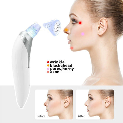 The Main Features Of The Acne Suction Tool Are That It Can